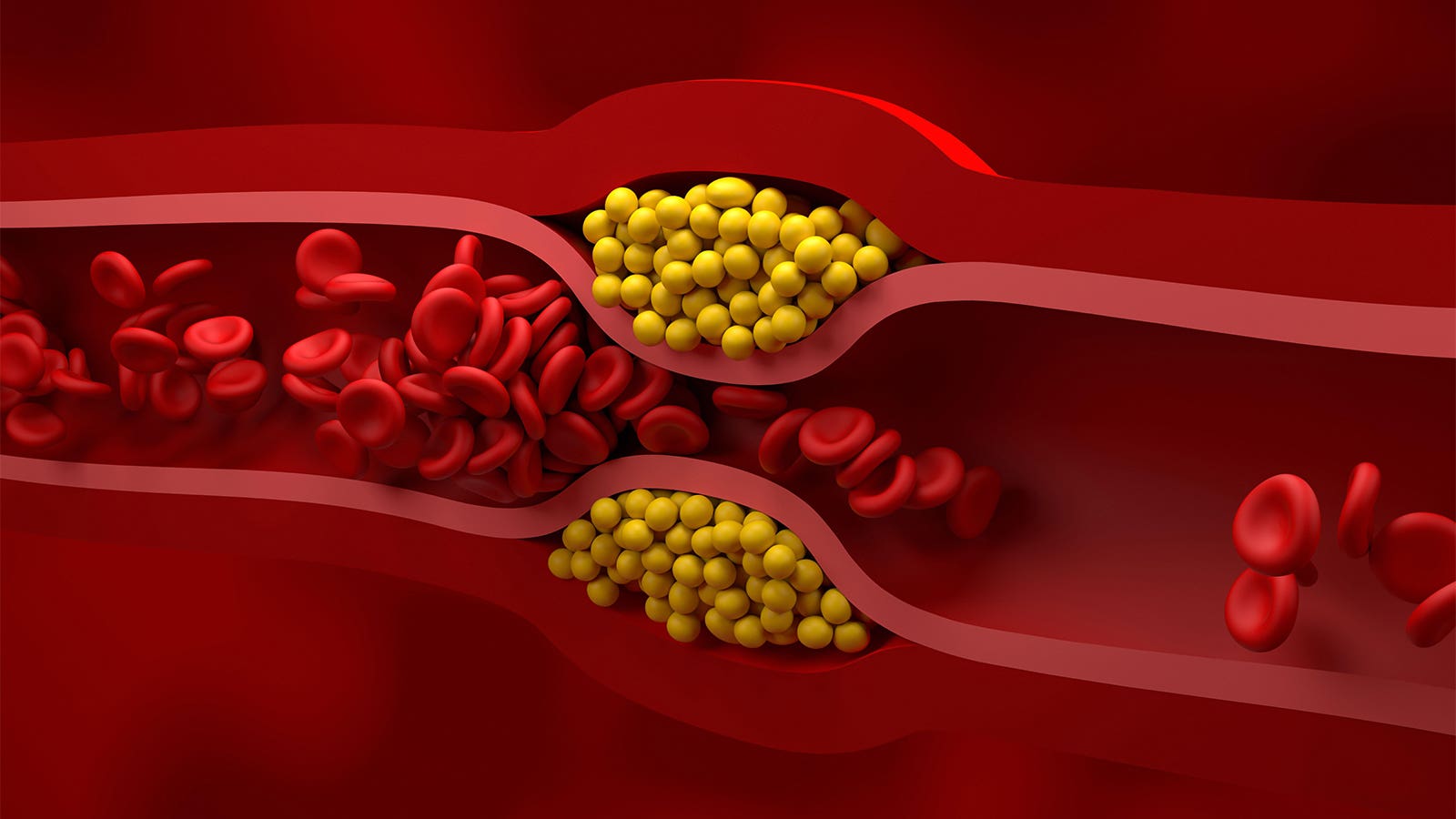 Plozasiran Paves RNA Interference Path to Triglyceride Reduction